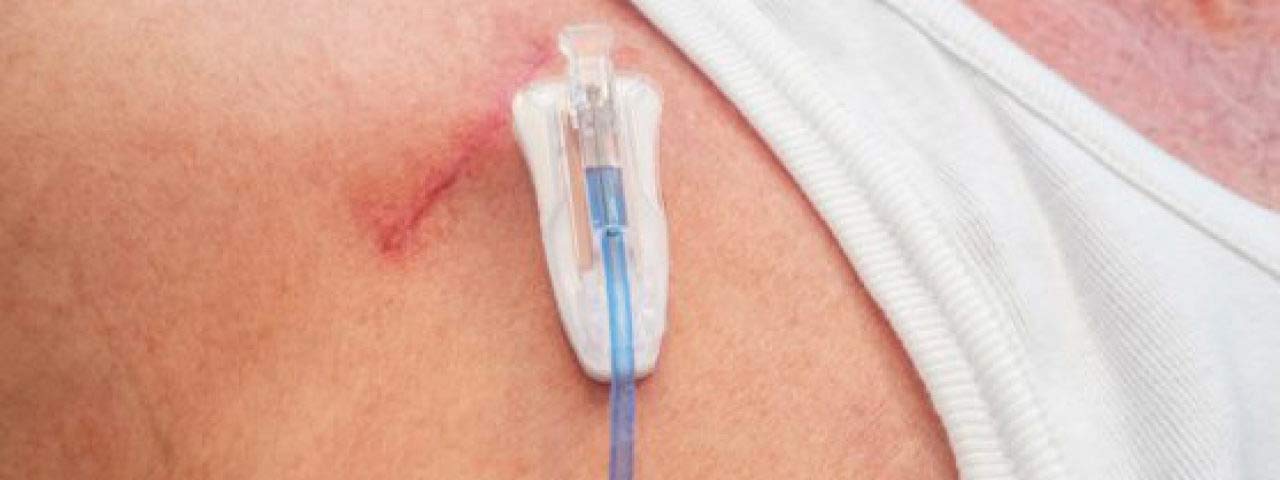 Chemoport-Care Chemoport-Care