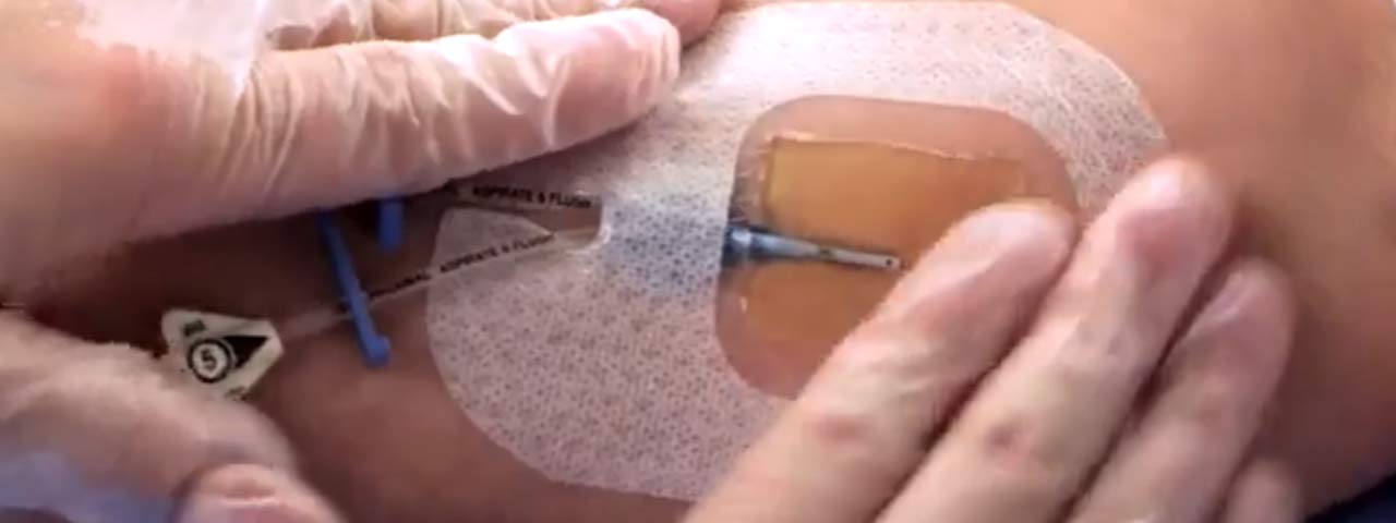 Dialysis-Line-Dressing Dialysis-Line-Dressing